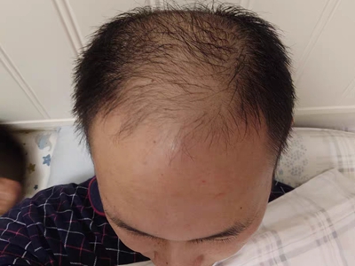 雄激素性脫髮前額到頭頂的頭髮快禿了圖 雄激素性脫髮前額到頭頂的頭髮快禿了圖