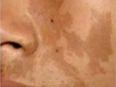 咖啡斑臉上有多處不規則的咖啡色斑圖 咖啡斑臉上有多處不規則的咖啡色斑圖