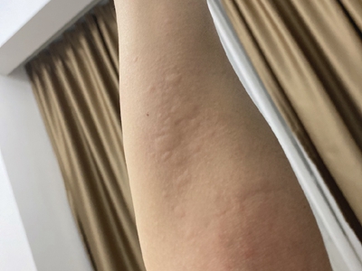 海鮮過敏胳膊上好多大小不等的風團圖 海鮮過敏胳膊上好多大小不等的風團圖
