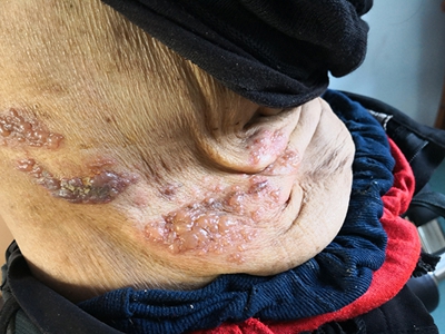 愛滋病感染性皮膚損害腹部很多水皰圖