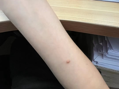 皮膚纖維瘤胳膊內側出現一個小圓疙瘩圖 皮膚纖維瘤胳膊內側出現一個小圓疙瘩圖