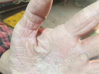 手部濕疹左手手掌及手指部位皮膚增厚圖 手部濕疹左手手掌及手指部位皮膚增厚圖