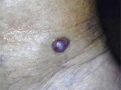 愛滋病皮膚腫瘤腳踝有一個紫紅色結節圖 愛滋病皮膚腫瘤腳踝有一個紫紅色結節圖