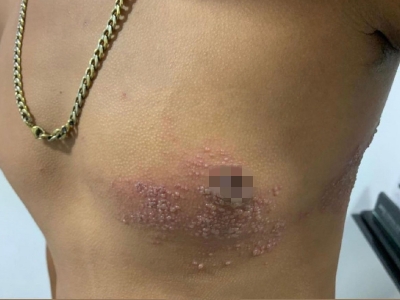 愛滋病感染性皮膚損害胸部簇集性水皰圖 愛滋病感染性皮膚損害胸部簇集性水皰圖