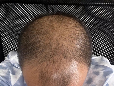 雄激素性脫髮頭頂頭髮稀少油膩泛光圖 雄激素性脫髮頭頂頭髮稀少油膩泛光圖