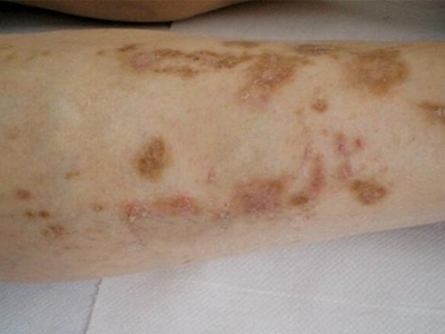 糖尿病性皮膚病小腿上有好多褐色斑塊圖 糖尿病性皮膚病小腿上有好多褐色斑塊圖