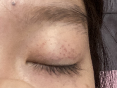 血管內壓力增多性紫癜上眼皮有紅點點圖