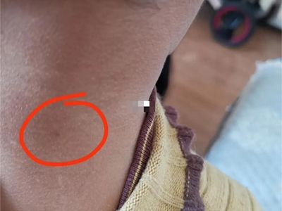 咖啡斑後脖子上有較小的淺咖啡色斑圖