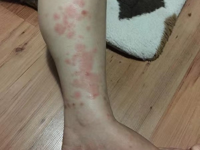糖尿病性皮膚病小腿上起了好多紅斑圖 糖尿病性皮膚病小腿上起了好多紅斑圖