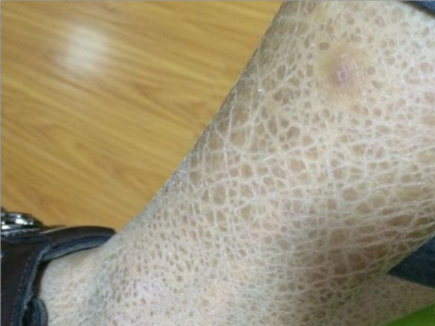 先天性外胚葉發育不良小腿有褐色斑片圖