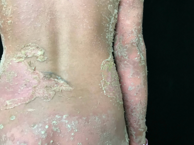 泛發性膿皰型銀屑病全身大面積脫皮圖 泛發性膿皰型銀屑病全身大面積脫皮圖
