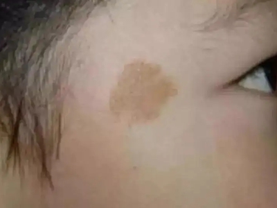 咖啡斑顳部有圓形的邊界清楚的棕色斑圖 咖啡斑顳部有圓形的邊界清楚的棕色斑圖