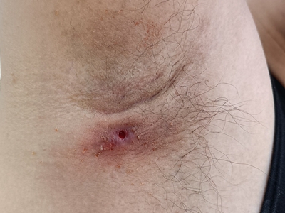 皮脂腺囊腫腋窩紅腫出現較深的小孔圖 皮脂腺囊腫腋窩紅腫出現較深的小孔圖
