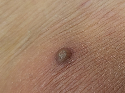 皮脂腺囊腫胳膊局部出現一個硬結節圖 皮脂腺囊腫胳膊局部出現一個硬結節圖