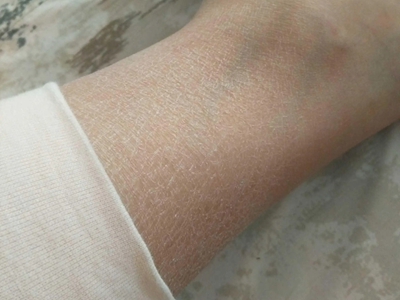 糖尿病性皮膚病小腿皮膚乾燥起白屑圖 糖尿病性皮膚病小腿皮膚乾燥起白屑圖