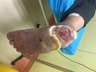 慢性乳頭狀潰瘍性膿皮病腳後跟有糜爛圖 慢性乳頭狀潰瘍性膿皮病腳後跟有糜爛圖
