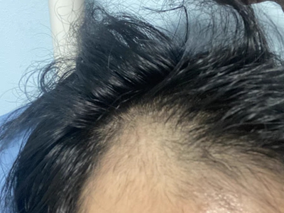 雄激素性脫髮右側額角頭髮快掉沒了圖 雄激素性脫髮右側額角頭髮快掉沒了圖