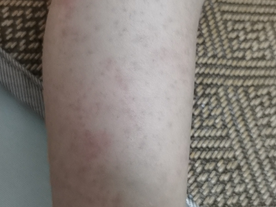 血管內壓力增多性紫癜腿上全是淡紅斑圖 血管內壓力增多性紫癜腿上全是淡紅斑圖