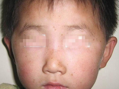 遺傳性對稱性色素異常症面部長好多斑圖 遺傳性對稱性色素異常症面部長好多斑圖