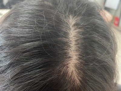 雄激素性脫髮頭頂中間位置頭髮稀少圖 雄激素性脫髮頭頂中間位置頭髮稀少圖