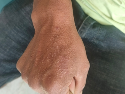繼發性粟丘疹手背有密密麻麻白色結節圖 繼發性粟丘疹手背有密密麻麻白色結節圖