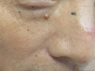 孤立性毛髮上皮瘤眼睛下長一圓疙瘩圖