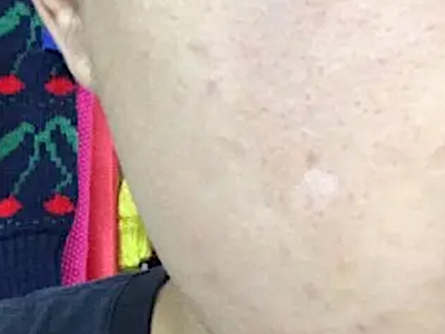 硬化性汗腺導管癌臉上有一塊白色結節圖 硬化性汗腺導管癌臉上有一塊白色結節圖