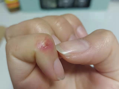 手部濕疹右手小指第一個關節處有紅斑圖 手部濕疹右手小指第一個關節處有紅斑圖