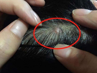 網狀組織細胞肉芽腫頭皮上有小疙瘩圖 網狀組織細胞肉芽腫頭皮上有小疙瘩圖