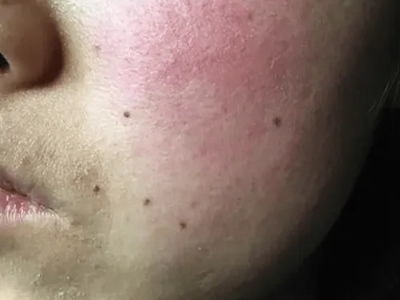 糖皮質激素依賴性皮炎臉上紅腫伴凹坑圖 糖皮質激素依賴性皮炎臉上紅腫伴凹坑圖