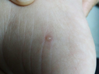 嬰兒肢端膿皰病腳部長個半球形小水皰圖 嬰兒肢端膿皰病腳部長個半球形小水皰圖