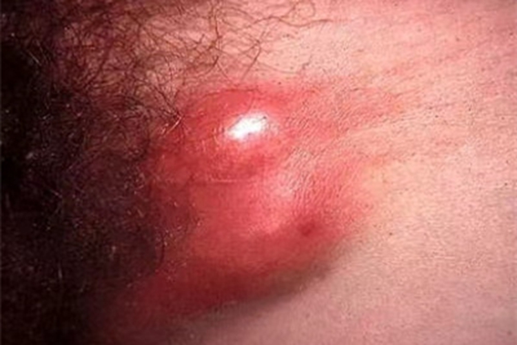 中期性病性淋巴肉芽腫大腿根鼓起腫塊圖