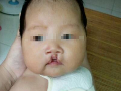 先天性外胚葉發育不良嘴唇中間缺損圖 先天性外胚葉發育不良嘴唇中間缺損圖