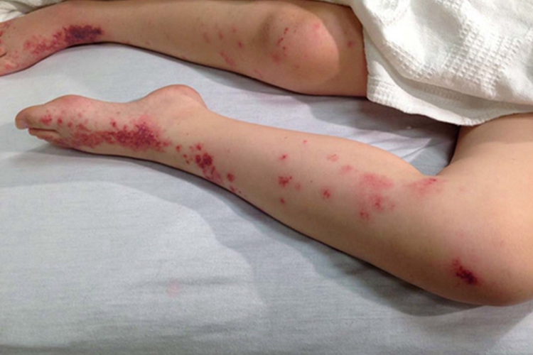 小兒過敏性紫癜小腿內側有鮮紅色斑片圖 小兒過敏性紫癜小腿內側有鮮紅色斑片圖
