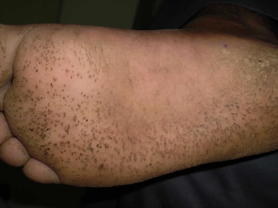 溝狀跖部角質松解症腳底布滿黑色小坑圖
