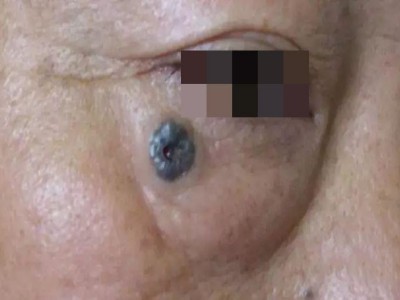 結節型黑色素瘤眼周有黑色結節潰爛圖 結節型黑色素瘤眼周有黑色結節潰爛圖