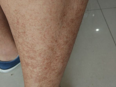 網狀肢端色素沉著小腿有好多褐色斑塊圖 網狀肢端色素沉著小腿有好多褐色斑塊圖