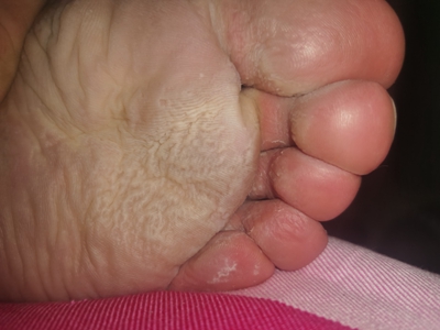 窩狀角質松解症腳底皮膚鬆弛並脫落圖 窩狀角質松解症腳底皮膚鬆弛並脫落圖