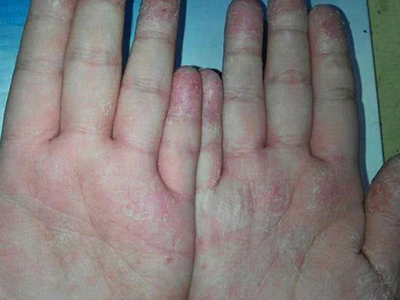 手部濕疹雙手手掌及指尖部位潮紅脫屑圖 手部濕疹雙手手掌及指尖部位潮紅脫屑圖