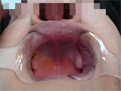 先天性外胚葉發育不良牙齒幾乎沒有了圖 先天性外胚葉發育不良牙齒幾乎沒有了圖