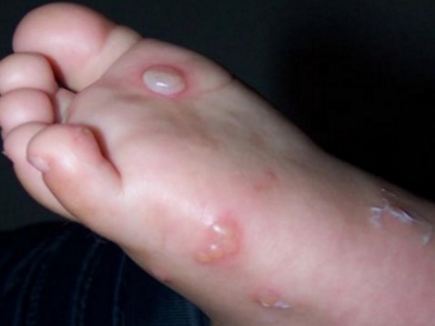 嬰兒肢端膿皰病腳底有白色和透明水皰圖 嬰兒肢端膿皰病腳底有白色和透明水皰圖