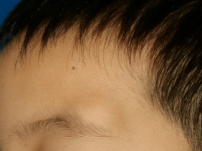 孤立性毛髮上皮瘤眉毛尾處鼓個大包圖 孤立性毛髮上皮瘤眉毛尾處鼓個大包圖