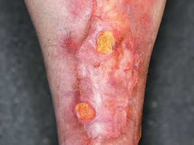糖尿病性皮膚病小腿皮膚潰爛不癒合圖 糖尿病性皮膚病小腿皮膚潰爛不癒合圖
