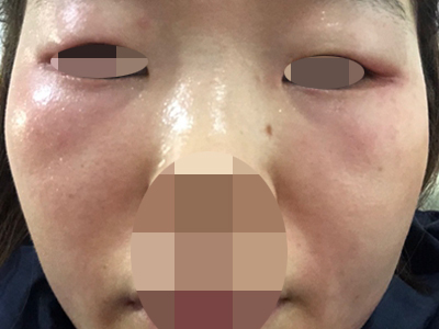 糖皮質激素依賴性皮炎臉上發紅腫脹圖 糖皮質激素依賴性皮炎臉上發紅腫脹圖