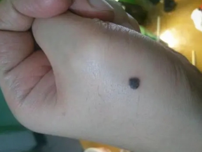 良性幼年黑素瘤手上有一顆黑色圓斑圖 良性幼年黑素瘤手上有一顆黑色圓斑圖