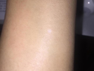 特發性滴狀色素減少症胳膊上起白點圖 特發性滴狀色素減少症胳膊上起白點圖