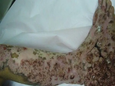 著色真菌病小腿和腳部皮膚糜爛結黑痂圖 著色真菌病小腿和腳部皮膚糜爛結黑痂圖