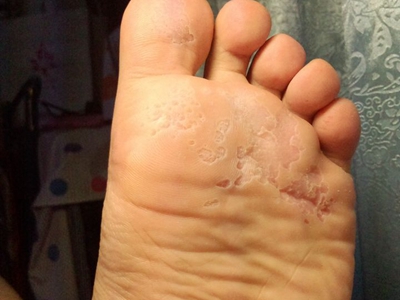 溝狀跖部角質松解症腳底脫皮連成片圖