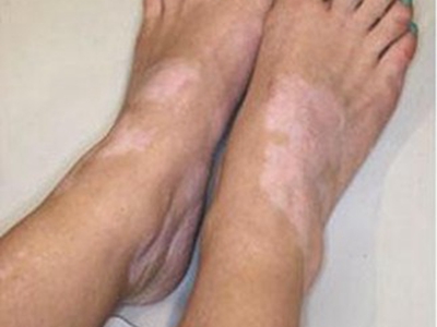 貧血痣腳背白了一大片圖 貧血痣腳背白了一大片圖