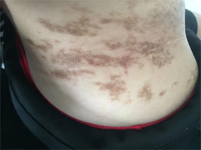 網狀肢端色素沉著側腰有大片褐色斑塊圖